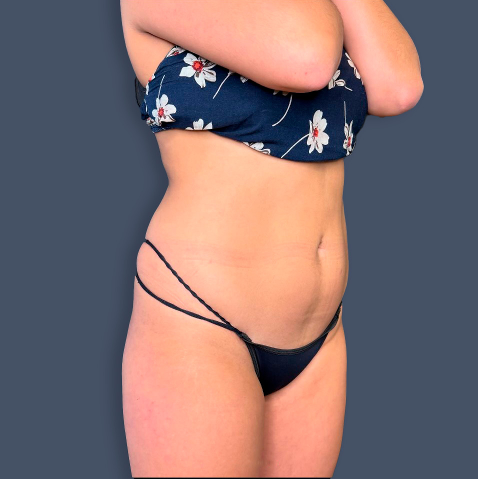 Lipofit 360° — Prima