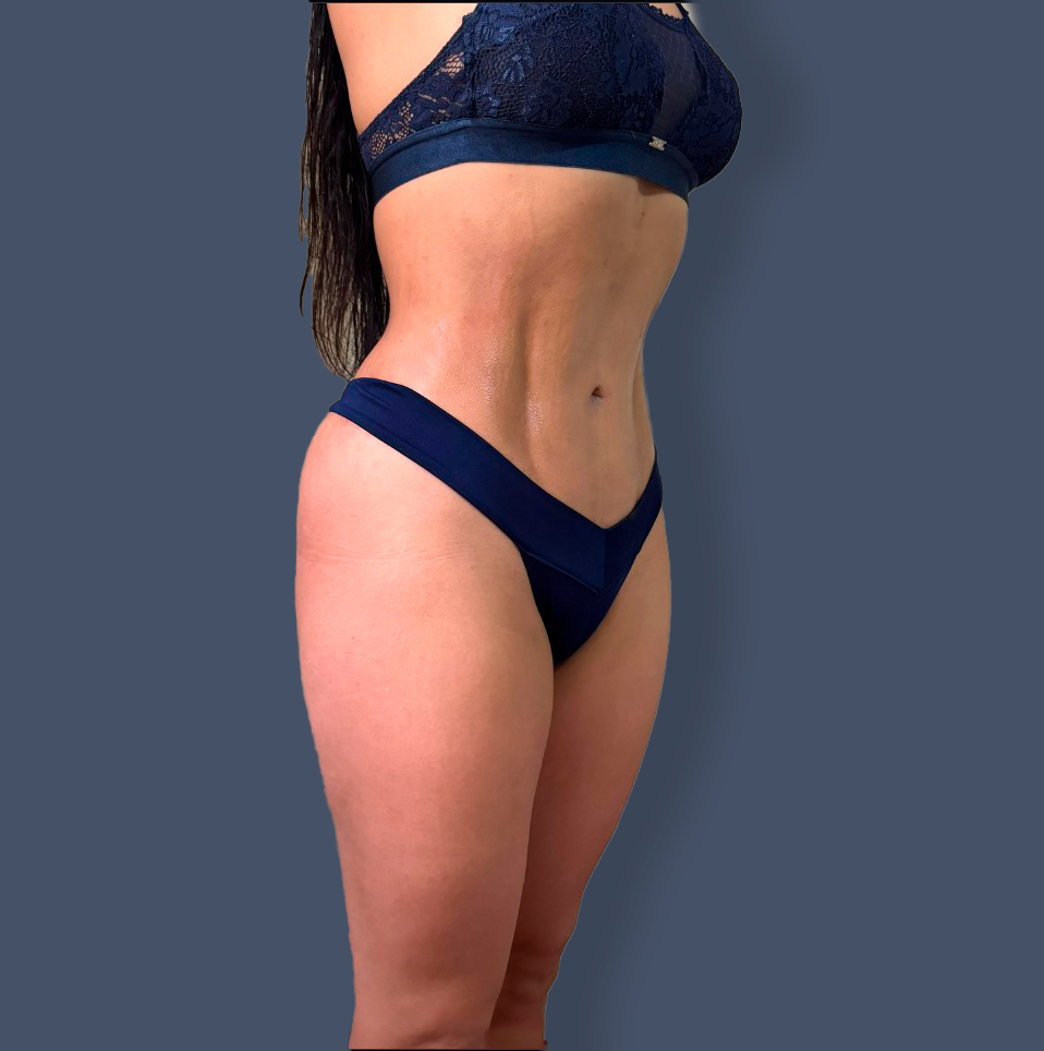 Lipofit 360° — Dopo